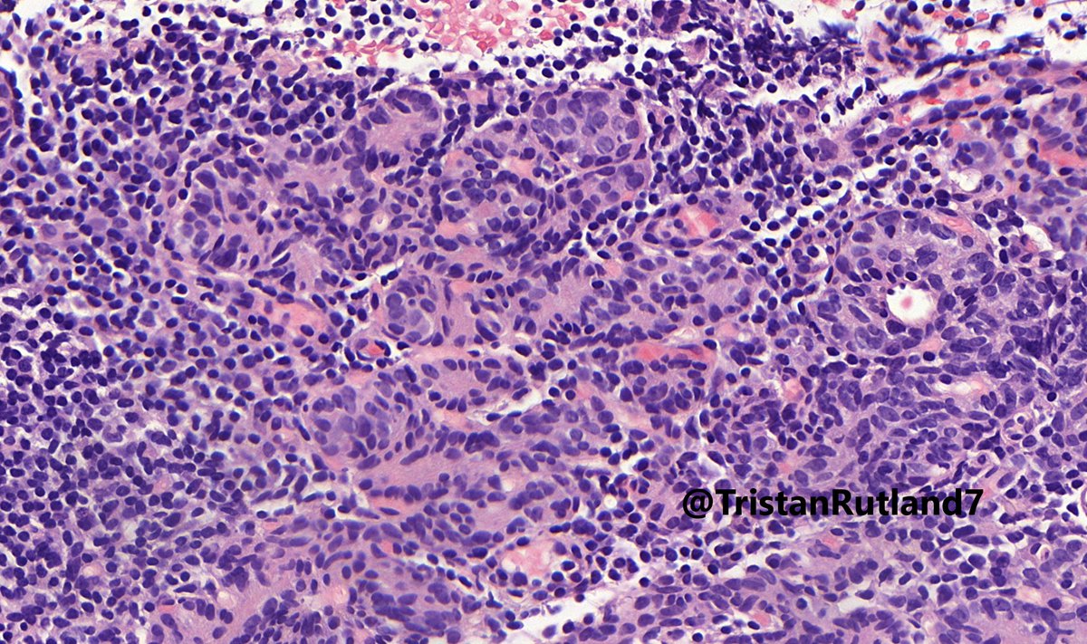 Chest mass, adult

#Pulmpath #BSTpath #Endopath #Pathresidents #Pathtwitter