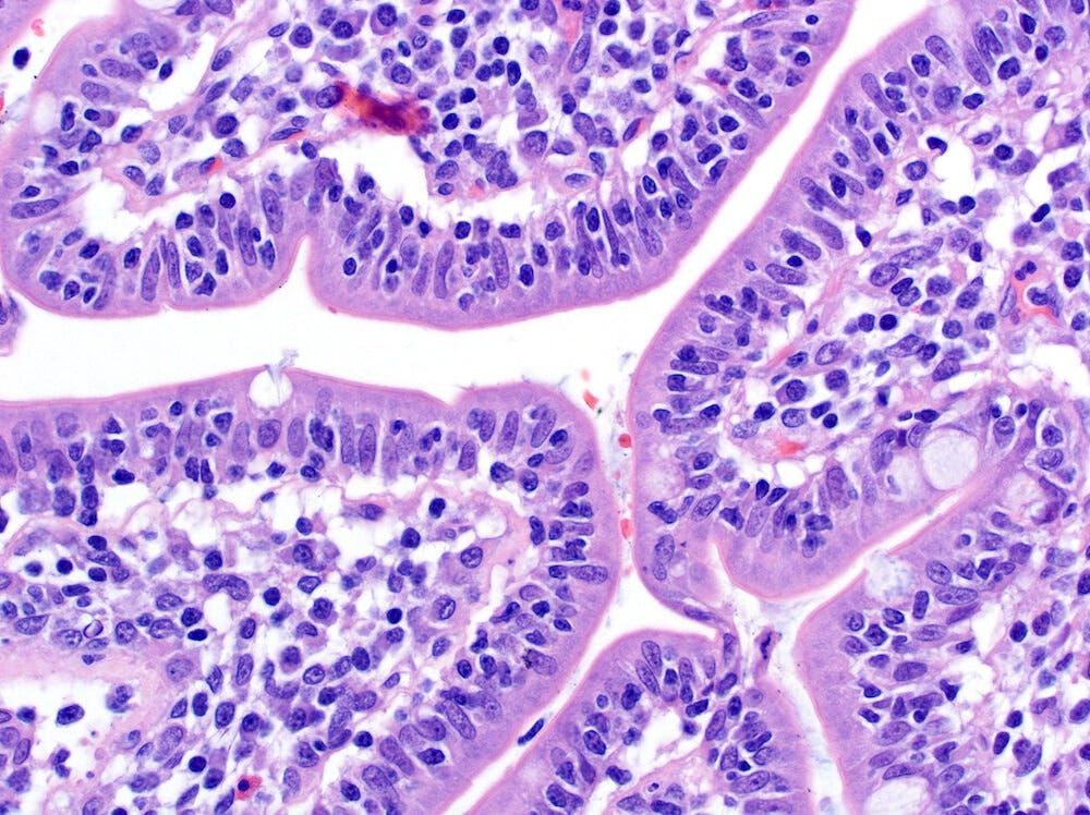 Pathoutlines's tweet photo. Cancer Precursor Project – Characteristics Of Premalignant Precursors, Part 5b (Hematopathology)
This essay further discusses precursors associated with hematologic malignancies.
Essay: https://t.co/GTyS18LeSK
#PathX #CuringCancerNetwork #CancerResearch #PathologyOutlines https://t.co/dtLOS84eu3