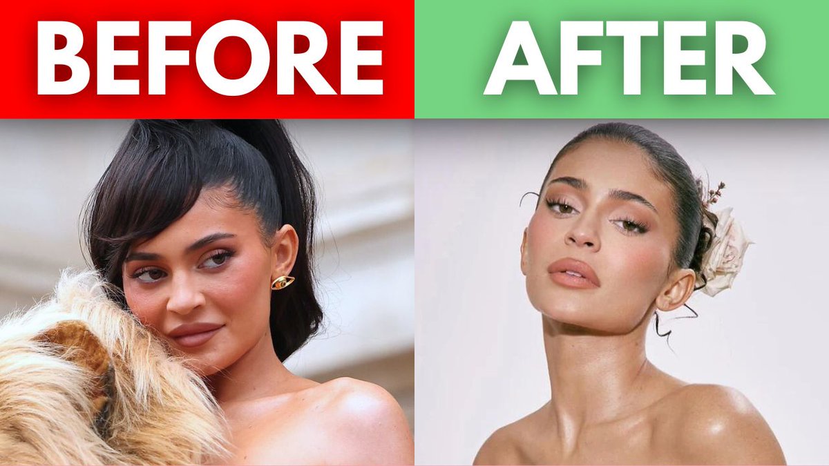 plastixdocs's tweet image. 🚨 LIP FILLERS &amp;amp; ‘PILLOW FACE’ Syndrome: Are You At Risk? 💉 Curious about the risks of lip fillers and the &apos;pillow face&apos; effect? Get advice on what you need to know before getting fillers in your 20s. 👉 WATCH NOW #ForeverYoungPodcast #LipFiller  l8r.it/ImOQ