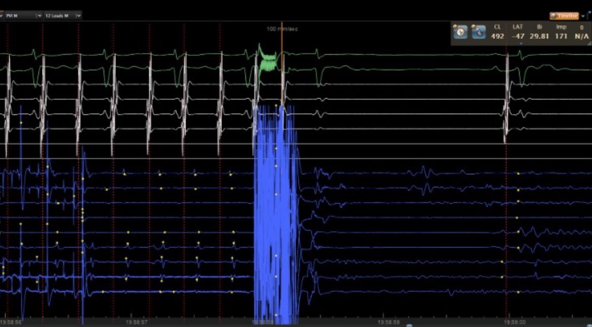 GustavoRRodrigues (@life_activist_) on Twitter photo Atypical flutter mapping and ablation with #Varipulse <a href="/jjmt_ep/">Johnson & Johnson MedTech | Electrophysiology</a> <a href="/cgmarinescu/">Cătălin Marinescu</a> @Padragao @GMoraisFlor @SoniaMonteiro <a href="/gmoraisflor/">Guilherme Flor</a>
Hospital Santa Cruz, Carnaxide Atypical flutter mapping and ablation with #Varipulse <a href="/jjmt_ep/">Johnson & Johnson MedTech | Electrophysiology</a> <a href="/cgmarinescu/">Cătălin Marinescu</a> @Padragao @GMoraisFlor @SoniaMonteiro <a href="/gmoraisflor/">Guilherme Flor</a>
Hospital Santa Cruz, Carnaxide