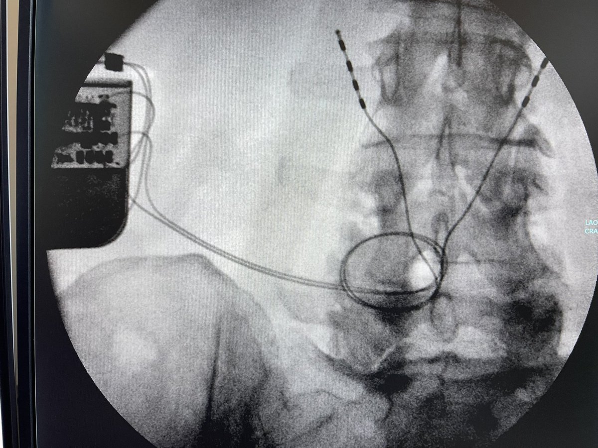 Glade Roper, MD - MSK/IR tweet media