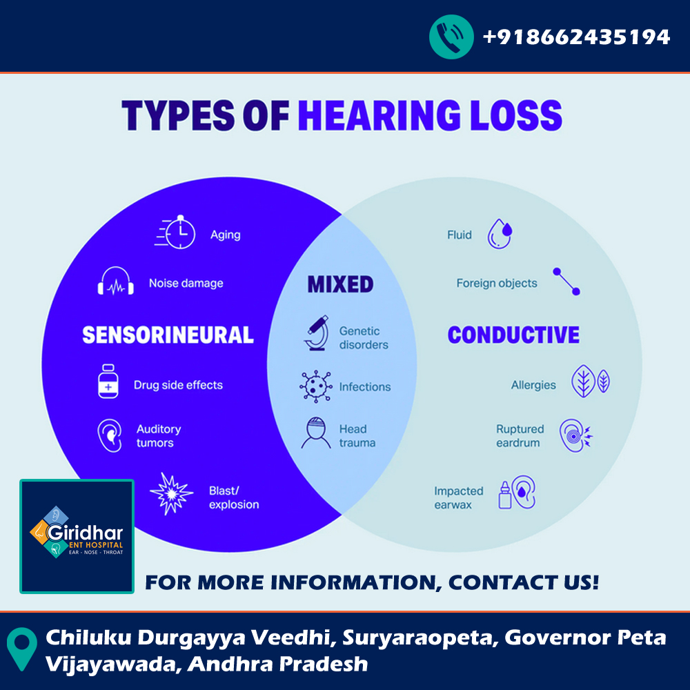 Giridhar_ENT's tweet photo. Sometimes a hearing loss can be as simple as too much earwax or a temporary ear infection.
For more information, consult with us.
#VijayawadaFloods #vijayawada #AndhraPradesh #Amaravathi #ent #ENTIssues #hearingloss #trending #Devara #trending #JrNTR #DevaraOnSep27th #News https://t.co/qgX1DbZsoD