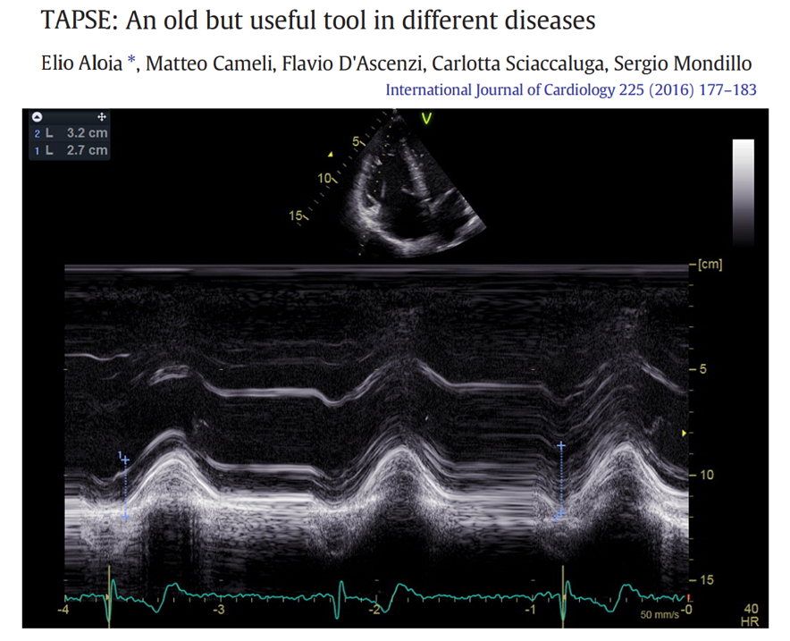 NephroP's tweet photo. #TAPSE - old, yet relevant!
#POCUS #FOAMed #FOAMcc https://t.co/vdxsoAWXAa