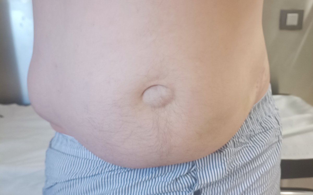 Abdominal hernia, a rare complication of autologous graft harvesting, two years after the surgery. A thorough closure of the muscles of the abdominal wall must be performed to avoid this complication. #orthotwitter 
Posted with permission.