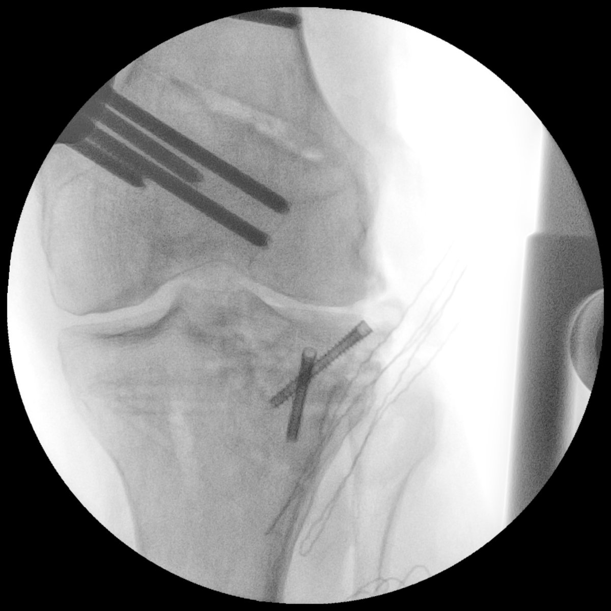 💥CWDFO &amp; lateral tibial plateau FRESH osteochondral transplantation💥
🚗 accident 1 year ago🤕