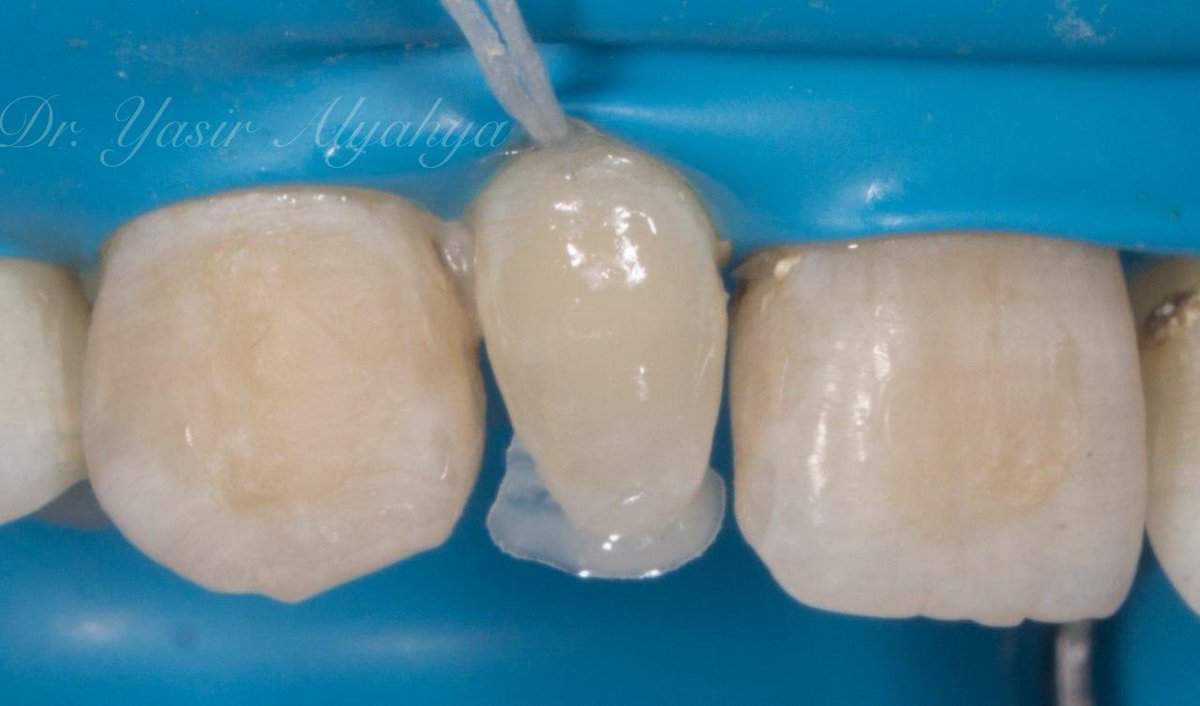 Yasir_Alyahya's tweet photo. علاج السن بـ حشوة تجميلية
 
Direct composite veneer https://t.co/5kAVcBpL6Z