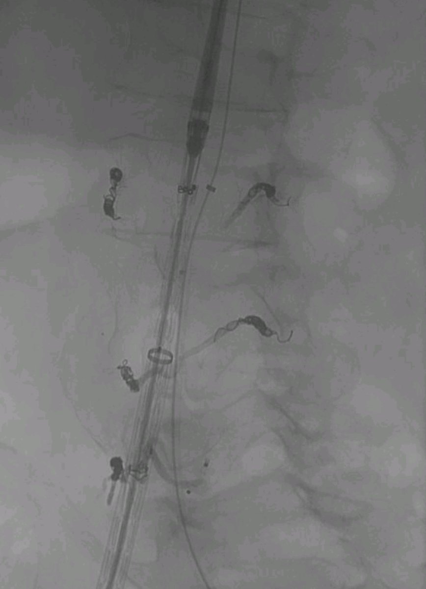 HAlGedaiby's tweet photo. مريض ألماني لديه تضخم في الشريان الأورطي ويعاني من ضمور في وظائف الكلى. عالجته بفضل من الله عن طريق القسطرة التداخلية وبدون استخدام الصبغة...
#EVAR https://t.co/mCM57G7tJP