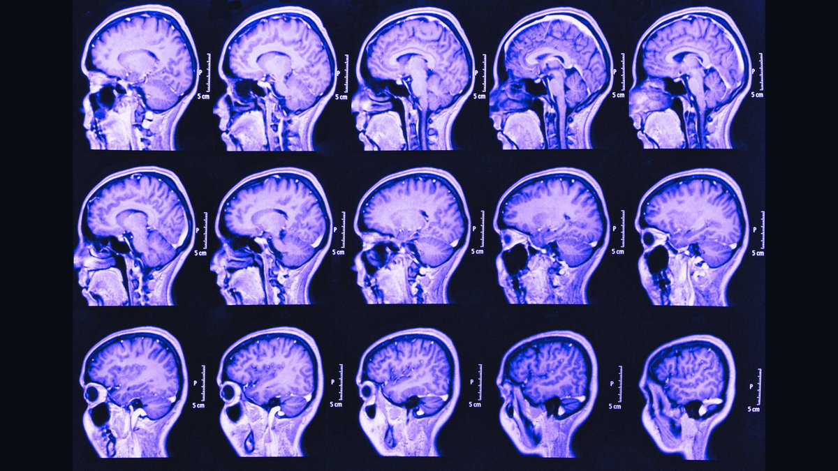 Epstein-Barr Virus (EBV) infection is associated with an increased risk of developing:
- Rheumatoid arthritis
- Multiple sclerosis
- Type 1 diabetes 
- Celiac disease
- Sjogren's 
- ME/CFS
- Lupus
- POTS

Here is why Long COVID should be added to this list...🧵