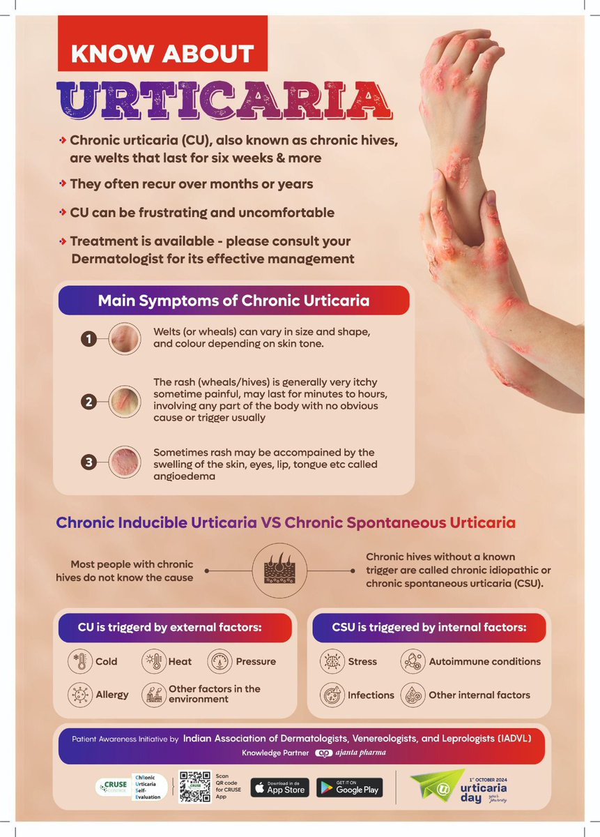 Urticaria can be very troublesome at times. Please consult your dermatologist for prompt and effective management 
#IADVL #Urticaria #dermatology