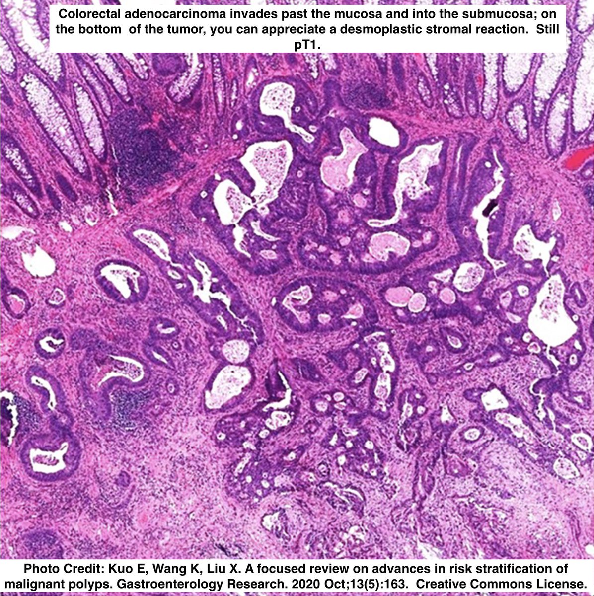 Path4People's tweet image. #histo ➡️ affect Staging

pT1 in esophagus ➡️ Invasion into Mucosa
pT1 in colon ➡️ Invasion into Submucosa (if only mucosa➡️pTis)

Esophagus mucosa has more robust lymphatics in mucosa, ⬆️ risk for lymph spread

#pathx #surgonc #surgery #medicine #medx #medicalstudent #pathagonia