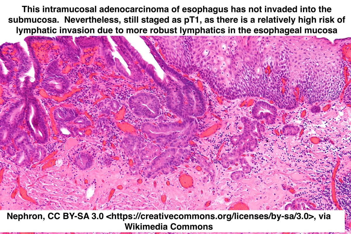 Path4People's tweet image. #histo ➡️ affect Staging

pT1 in esophagus ➡️ Invasion into Mucosa
pT1 in colon ➡️ Invasion into Submucosa (if only mucosa➡️pTis)

Esophagus mucosa has more robust lymphatics in mucosa, ⬆️ risk for lymph spread

#pathx #surgonc #surgery #medicine #medx #medicalstudent #pathagonia