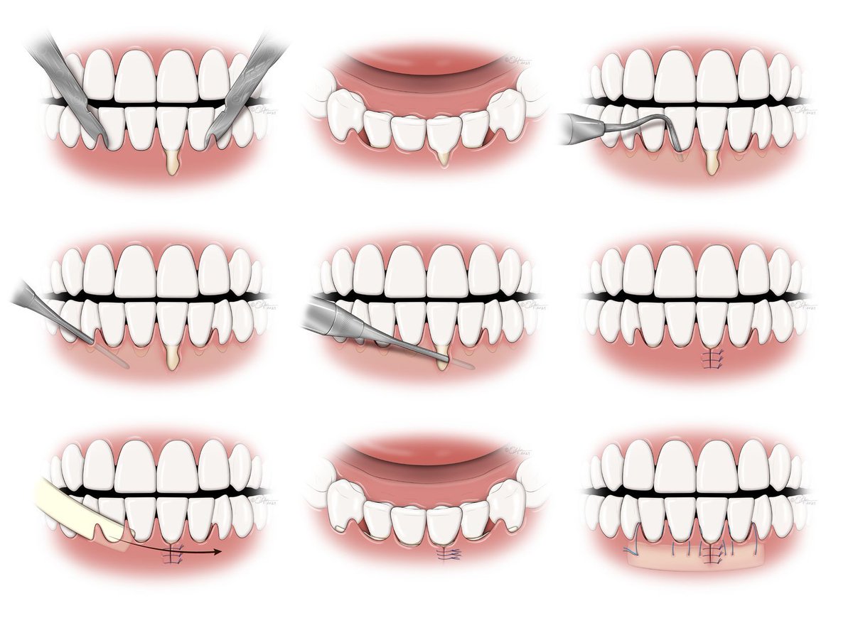 Medical Illustration & Animation (@medillustrates) on Twitter photo A series of dental/periodontal illustrations by <a href="/studiohromi/">Emily Hromi</a> depicting the steps of surgical techniques for the treatment of deep gingival recession.
Explore more work by Emily Hromi: buff.ly/31mA1ds
#dental #periodontal #dentistry #dentalsurgery #medical #illustration A series of dental/periodontal illustrations by <a href="/studiohromi/">Emily Hromi</a> depicting the steps of surgical techniques for the treatment of deep gingival recession.
Explore more work by Emily Hromi: buff.ly/31mA1ds
#dental #periodontal #dentistry #dentalsurgery #medical #illustration