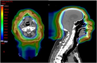 Advances_ASTRO's tweet photo. 🤯Taming the 🦁: Proton Therapy for Severe Leonine Facies from cutaneous T-cell lymphoma (CTCL)🤯

🔥RT is incredibly effective for symptom palliation from CTCL!

Simply put - RT in this case enabled a new opportunity and “new view” at independent life

https://t.co/ToFBvEvwEr https://t.co/drbiGfKGeZ