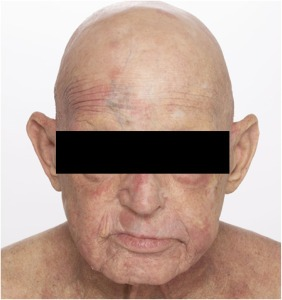 Advances_ASTRO's tweet photo. 🤯Taming the 🦁: Proton Therapy for Severe Leonine Facies from cutaneous T-cell lymphoma (CTCL)🤯

🔥RT is incredibly effective for symptom palliation from CTCL!

Simply put - RT in this case enabled a new opportunity and “new view” at independent life

https://t.co/ToFBvEvwEr https://t.co/drbiGfKGeZ