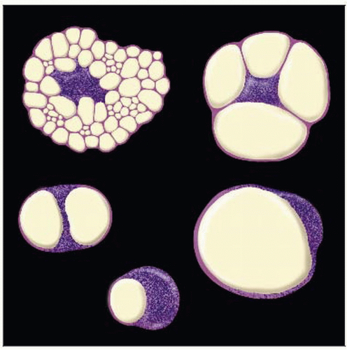 thejourneymate's tweet photo. Different Facets of Lipoblasts: In Illustration 🔬

The cytoplasm is filled with lipid that appears as one or multiple clean, punched-out vacuoles that indent and scallop the nucleus.

https://t.co/kF04owZ51X https://t.co/eDhBS3cDUW