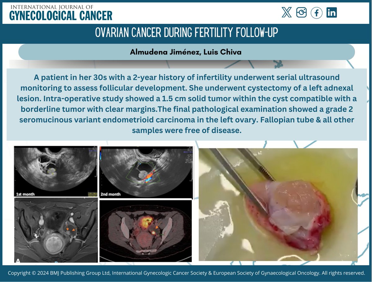 IJGC (@ijgconline) on Twitter photo #Images
Ovarian cancer during fertility follow-up by <a href="/lchiv4/">Luis Chiva</a>
🔗 bit.ly/3YcqS4p
<a href="/pedroramirezMD/">Pedro T Ramirez</a> <a href="/HsuMd/">Arthur_HC_Hsu</a> <a href="/JayrajAarthi/">Aarthi S Jayraj</a> <a href="/AndreFernandes2/">Andreina Fernandes</a> <a href="/IGCSociety/">IGCS</a> <a href="/ESGO_society/">ESGO</a> <a href="/ENYGO_official/">European Network of Young Gynae Oncologists</a> <a href="/OncoAlert/">OncoAlert</a> <a href="/IJGCfellows/">IJGC Fellows</a> <a href="/GynMe4/">SoMe4GynOnc</a> <a href="/RParejaGineOnco/">René Pareja</a> <a href="/lchiv4/">Luis Chiva</a> <a href="/annafagottimd/">Anna Fagotti</a> <a href="/Frumovitz/">Michael Frumovitz</a> #Images
Ovarian cancer during fertility follow-up by <a href="/lchiv4/">Luis Chiva</a>
🔗 bit.ly/3YcqS4p
<a href="/pedroramirezMD/">Pedro T Ramirez</a> <a href="/HsuMd/">Arthur_HC_Hsu</a> <a href="/JayrajAarthi/">Aarthi S Jayraj</a> <a href="/AndreFernandes2/">Andreina Fernandes</a> <a href="/IGCSociety/">IGCS</a> <a href="/ESGO_society/">ESGO</a> <a href="/ENYGO_official/">European Network of Young Gynae Oncologists</a> <a href="/OncoAlert/">OncoAlert</a> <a href="/IJGCfellows/">IJGC Fellows</a> <a href="/GynMe4/">SoMe4GynOnc</a> <a href="/RParejaGineOnco/">René Pareja</a> <a href="/lchiv4/">Luis Chiva</a> <a href="/annafagottimd/">Anna Fagotti</a> <a href="/Frumovitz/">Michael Frumovitz</a>