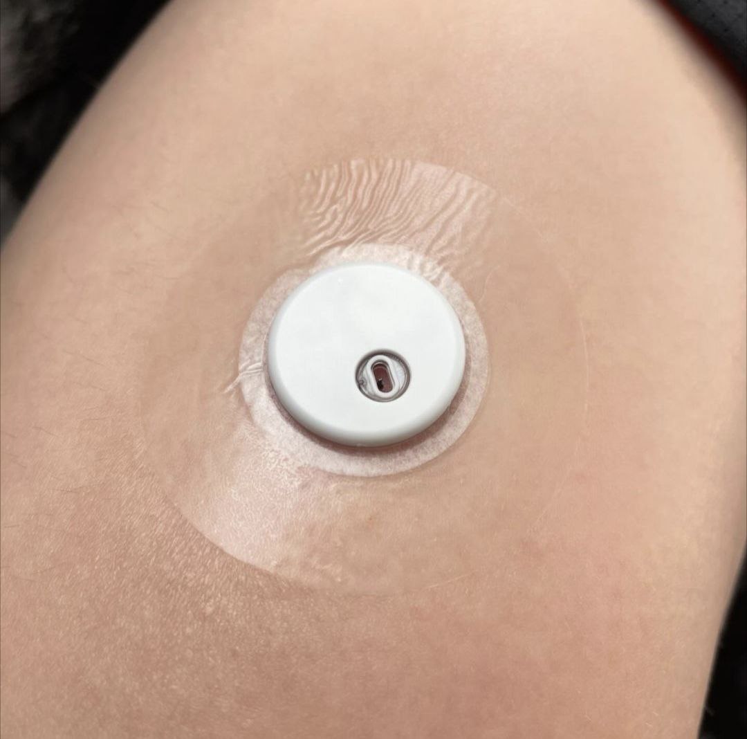 LexcamMD's tweet image. Dive into life's adventures with our Lexcam patches for Libre 3 🚀

#freestylelibre3 #type1warrior #type1strong #diabeticproblems #type1diabeteslookslikeme #type1diabetics #t1dlife #t1dcommunity #freestylelibreabbott #freestylelibresensor #freestylelibreabott #typeonediabetic