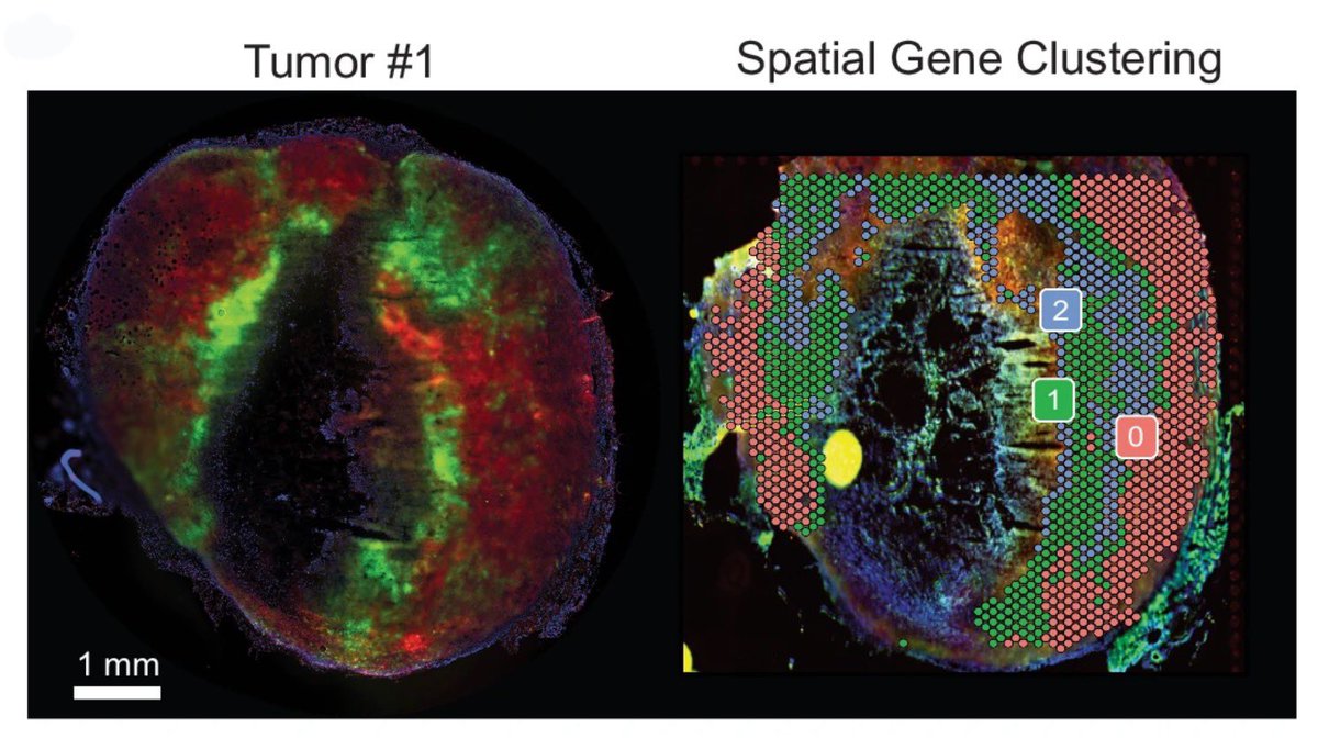 SpatialBioHub's tweet image. Hypoxia induces ROS-resistant memory upon reoxygenation in vivo promoting metastasis in part via
MUC1-C
👉 nature.com/articles/s4146… 👈

#TNBC #BreastCancer #pathology #FFPE #spatialbiology #spatialtranscriptomics