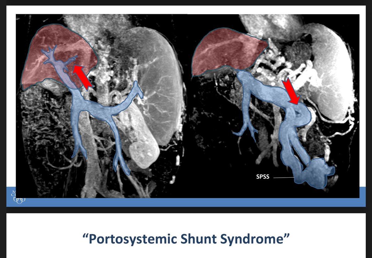 Beau Bosko Toskich, MD FSIR (@beautoskichmd) on Twitter photo <a href="/Portal360Mtg/">Portal 360 Meeting</a> is hands down the best avenue to educate and advance our understanding of #portalhypertension intervention. Thank you <a href="/Saad_VIR/">Wael Saad</a> <a href="/JafarGolzarian/">Jafar Golzarian, MD FSIR</a> <a href="/arslanmd/">Bulent Arslan, MD</a> for the opportunity to join the fun! <a href="/Portal360Mtg/">Portal 360 Meeting</a> is hands down the best avenue to educate and advance our understanding of #portalhypertension intervention. Thank you <a href="/Saad_VIR/">Wael Saad</a> <a href="/JafarGolzarian/">Jafar Golzarian, MD FSIR</a> <a href="/arslanmd/">Bulent Arslan, MD</a> for the opportunity to join the fun!