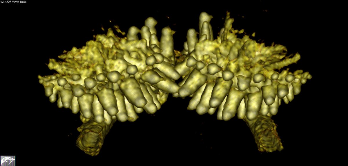 CT scan of Eumicrotremus orbis, revealing interesting features of the pharyngeal jaws. Lateral, dorsal, and posterior views of the jaws show the lower jaw protrudes way forward relative to the upper jaw. And the pharyngeal teeth are huge compared to the oral teeth! #lumpsucker