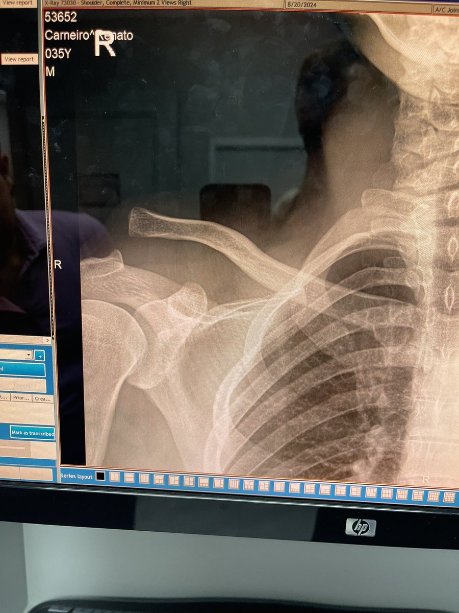 MMArena_'s tweet photo. INCROYABLE 😳

Moicano a combattu au 2eme round dans cet état.
Il s'est blessé 3 semaines avant le combat mais il n'a pas déclaré forfait. https://t.co/CbYoh2j0LS