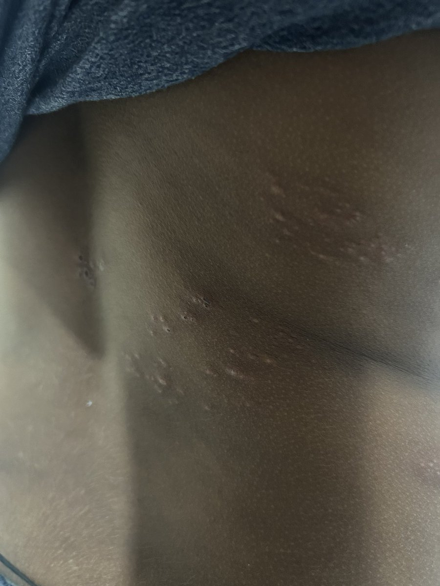 DrAkashRaut's tweet photo. 14yr old. C/O itching . What could be the possible diagnosis? @AnimeshDerma @dermatology https://t.co/JfDTUDge5M