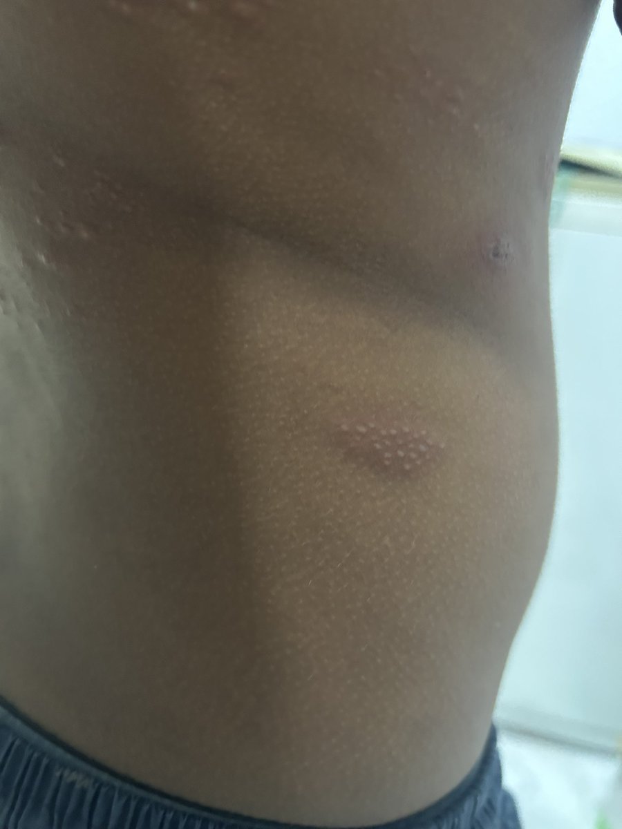 DrAkashRaut's tweet photo. 14yr old. C/O itching . What could be the possible diagnosis? @AnimeshDerma @dermatology https://t.co/JfDTUDge5M