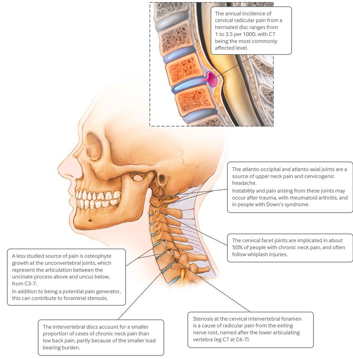 Nociceptive and Neuropathic drivers of Neck Pain 

📘 Cohen &amp; Hooten (2017), pubmed.ncbi.nlm.nih.gov/28807894/