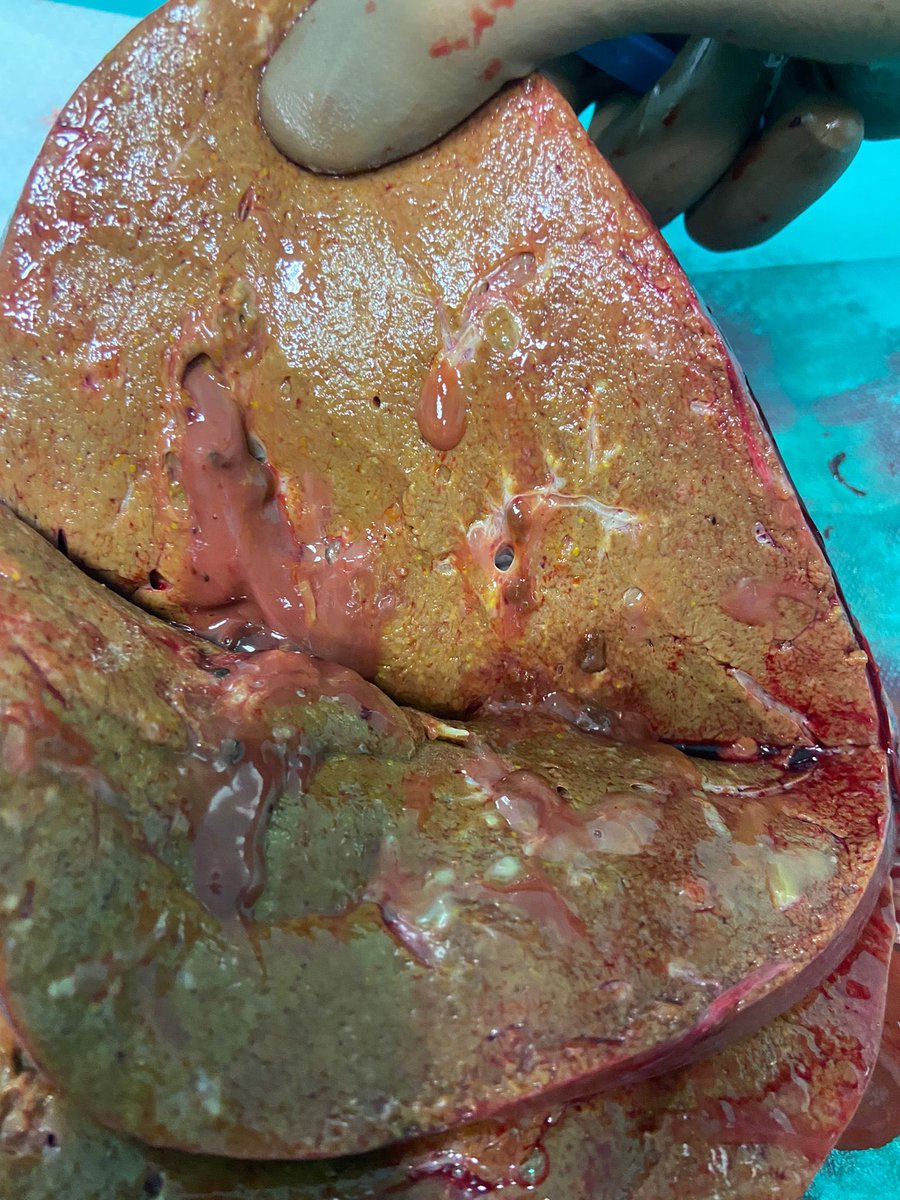 In Italy we always use NRP+HOPE for DCD livers and have the lowest incidence of ITBL.

This is the first #DCD #liver in my series of &gt;100 cases, that needed #retransplantation. It was recovered abroad without NRP and, despite HOPE, it developed massive ITBL in a few months.