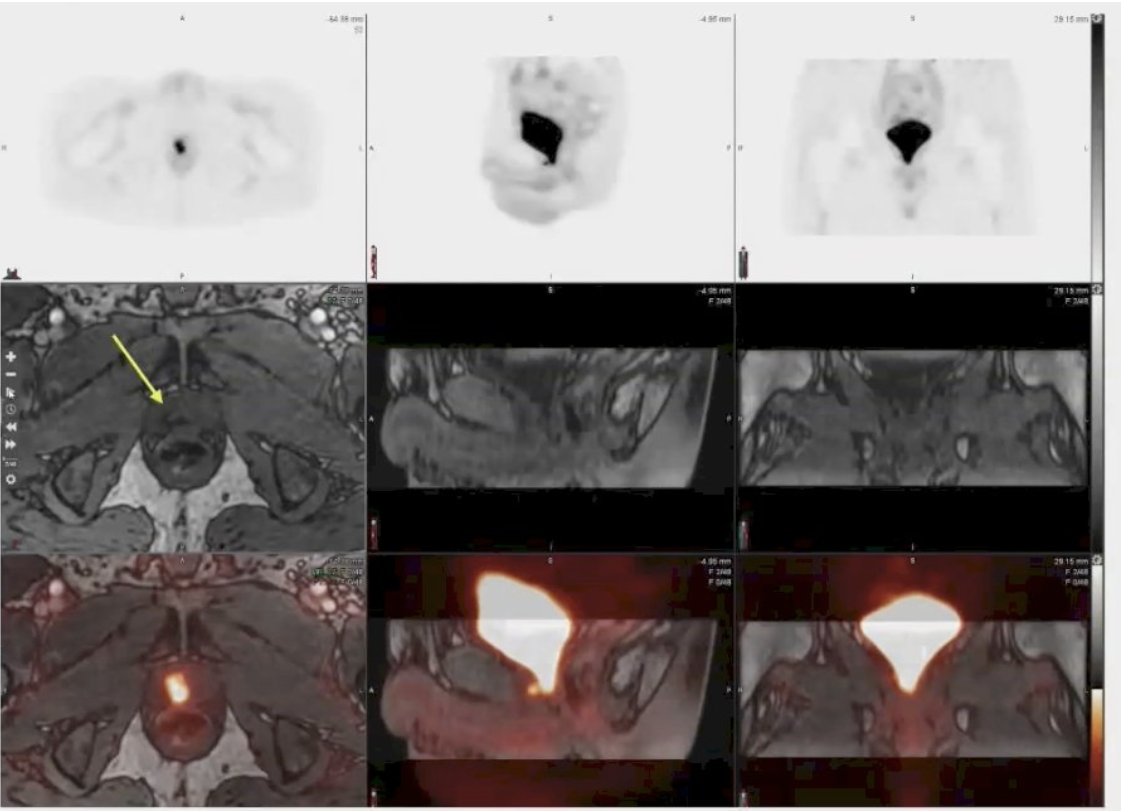 urotoday's tweet photo. A prospective pilot study investigating 18F rhPSMA-7.3 PET/MRI to detect recurrent disease and guide radiotherapy planning in pts with biochemically recurrent #ProstateCancer post-prostatectomy. @shilpa_surasi @MDAndersonNews. #ASTRO24 > https://t.co/W4kLNupXH4 @chavarriagaj https://t.co/vWDpZLhjEy