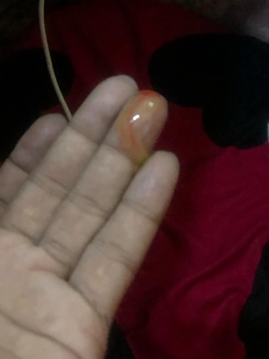 oyopos1's tweet photo. Good evening po Need ko po ng ulit ng help niyo po para makaluwas po ulit ako ng manila,subrang sakit po kasi tumubong bukol po sa lips ko meron po lumalabas na nana po..sana po matulongan niyo po ulit ako.Pls po gsto kung pumunta ng manila po ulit. https://t.co/uwXjBAH8C0