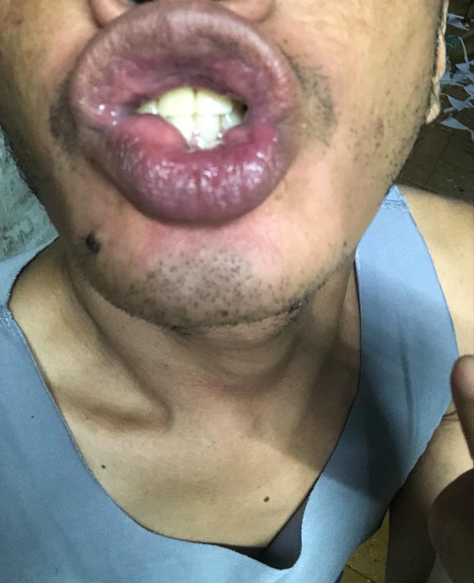 oyopos1's tweet photo. Good evening po Need ko po ng ulit ng help niyo po para makaluwas po ulit ako ng manila,subrang sakit po kasi tumubong bukol po sa lips ko meron po lumalabas na nana po..sana po matulongan niyo po ulit ako.Pls po gsto kung pumunta ng manila po ulit. https://t.co/uwXjBAH8C0