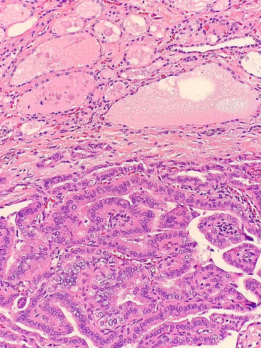 Gloria_SuraMD's tweet photo. Thyroidectomy revealing eosinophilic tumor cells with tall morphology adjacent to normal thyroid tissue. What is the diagnosis? Answer: https://t.co/WW10FsNbIA #PathArt #PathTwitter #MedTwitter https://t.co/uyhgSu1RJA