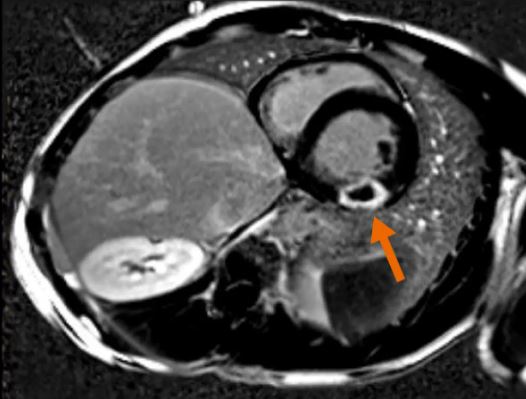 What makes #cardiacMRI at #siemenshealthineers different (1/4)? 
 
Our unique applications for CMR exams in #free-breathing! See what this means for patients on our new website: 
siemens-healthineers.com/magnetic-reson…
#CompressedSensingCardiacCine #PSIRHeartFreeze