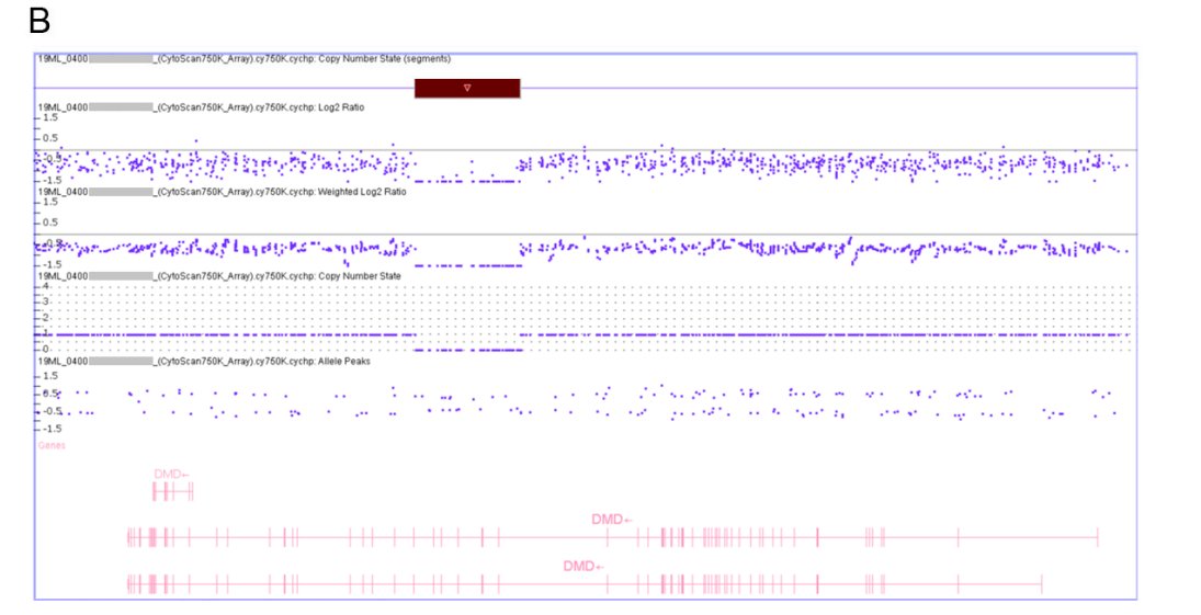 nikakhtar_ali's tweet photo. Diagnosis of Duchenne Muscular Dystrophy in a Presymptomatic Infant Using Next-Generation Sequencing and Chromosomal Microarray Analysis: A Case Report
👉 https://t.co/KuJg0obRX3
#DuchenneMuscularDystrophy #GeneticTesting #EarlyDiagnosis #NextGenerationSequencing #CreatineKinase https://t.co/waHHbY0hL0