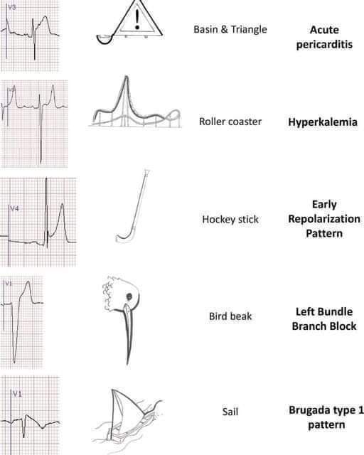 ZHeart11768530's tweet photo. 🔴 How to remember important #ECG changes: 

#cardiology #CardioTwitter #CardioEd #meded #medtwitter #diagnosis #FOAMed #clinical #ECG https://t.co/j3rpE14mv8