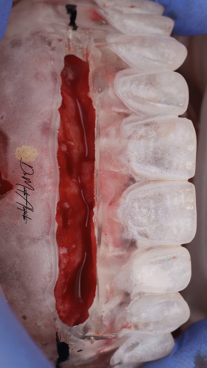 من مراحل اعادة تأهيل كامل للفكين عن طريق الزراعه..

تم فيها علاج بروز الاسنان واعادة الاطباق الوظيفي والجمالي للمراجع

بالتعاون مع د.مشاري المطيري
<a href="/Meshary_b/">مشاري بدر بن زريبان</a> في قسم التركيبات الثابتة والمتحركه

#زراعة_الاسنان
#التركيبات_الثابته
#التركيبات_المتحركه