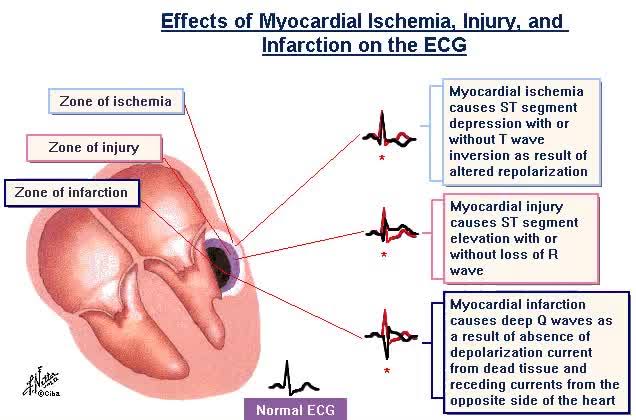 ZHeart11768530's tweet photo. 🔴ECG Changes of Myocardial Ischemia &amp; Infarction⤵️ 

🔹https://t.co/mNjoZduuEw
 #Cardiology #FOAMed #MedEd #medstudent #paramedic #Cardiology #CardioEd #medtwitter #meded #CardioTwitter #cardiotwiteros  #MedX #cardiovascular #MedTwitter #medical #medEd #cardiotwitter #medicine https://t.co/aPjNY4VJs4