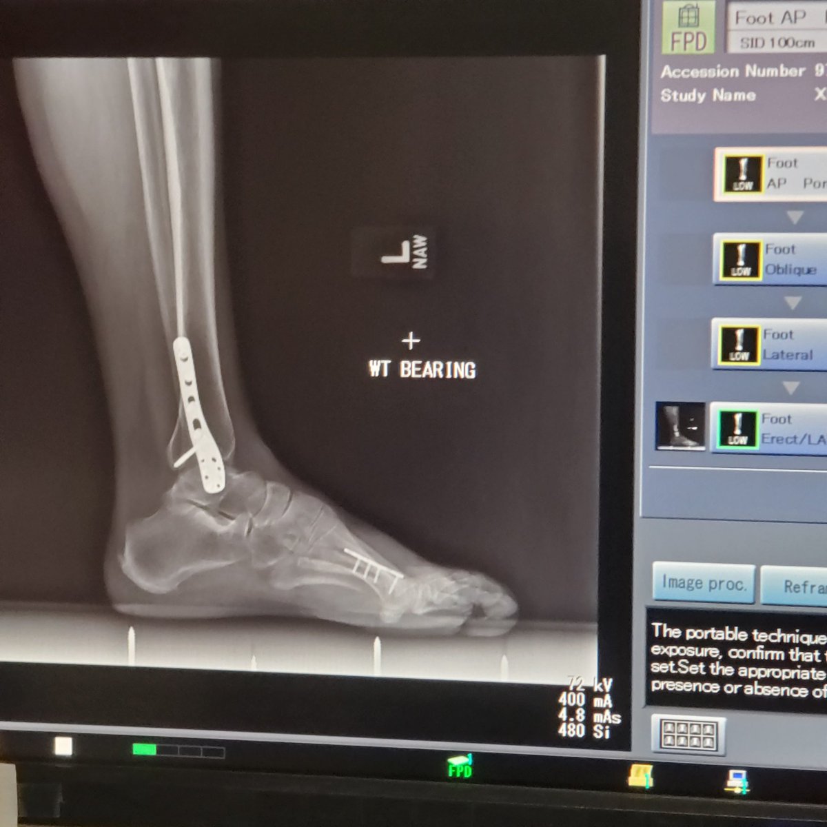 Xibalbakat's tweet photo. My mom recently broke her foot and got the 11 year old plate and screws that where sta4ting to come out, b33n busy taking care of her and trying my best to be present all that I can, but I do need help, I don't want to take on more comms but I would appreciate any kind of help. https://t.co/lHcrbw7kU8