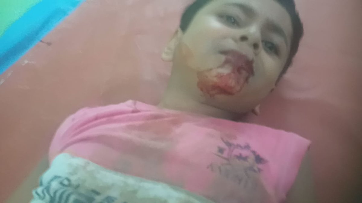 Kaushalendra99's tweet photo. कोतवाली देहात के हनुमानगंज बाजार में घर के सामने खड़े छः साल के मासूम को तेज रफ्तार बाइक सवार ने मारी टक्कर, आई गंभीर चोट, हालत नाज़ुक डाक्टरों ने किया लखनऊ रेफर टक्कर मारने वाला मुहम्मद नफीस पुत्र मुहम्मद रफीक हनुमान गंज बाजार का है।
@sultanpurpolice @Uppolice https://t.co/oP5Y74Iosr
