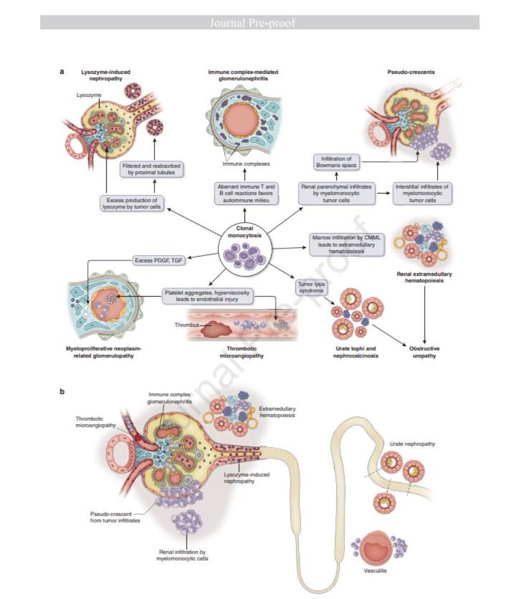 Mrinal Patnaik (@mrinalpatnaik) on Twitter photo Clonal Monocytosis of Renal Significance #CMRS pubmed.ncbi.nlm.nih.gov/39299498/ #Lysozyme #EMH #ICGN #Monocytes #MPN-G #CMML #CMUS #CCMUS <a href="/MPAlexanderMD/">Priya Alexander, MD</a> Nelson Leung <a href="/MayoCancerCare/">Mayo Clinic Comprehensive Cancer Center</a> <a href="/MayoClinicNeph/">Mayo Clinic Nephrology</a> Clonal Monocytosis of Renal Significance #CMRS pubmed.ncbi.nlm.nih.gov/39299498/ #Lysozyme #EMH #ICGN #Monocytes #MPN-G #CMML #CMUS #CCMUS <a href="/MPAlexanderMD/">Priya Alexander, MD</a> Nelson Leung <a href="/MayoCancerCare/">Mayo Clinic Comprehensive Cancer Center</a> <a href="/MayoClinicNeph/">Mayo Clinic Nephrology</a>