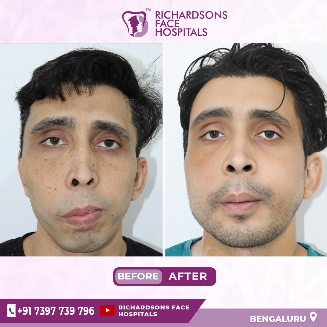 Jaw correction surgery @ Richardsons Face. Hospitals 
WhatsApp 9443182860 
#jaw #faces #maxfax