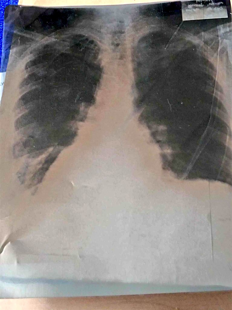 Hi, I'm Margina Rose Jerry, 18 years old 
I have water in my lungs and I also have a lump in my vagina, I need surgery to live I would like to ask for your help for my surgery, I hope you understand my situation.
ko-fi.com/rose400750/goa…
#commissionsoopen 
#fundriser 
#share