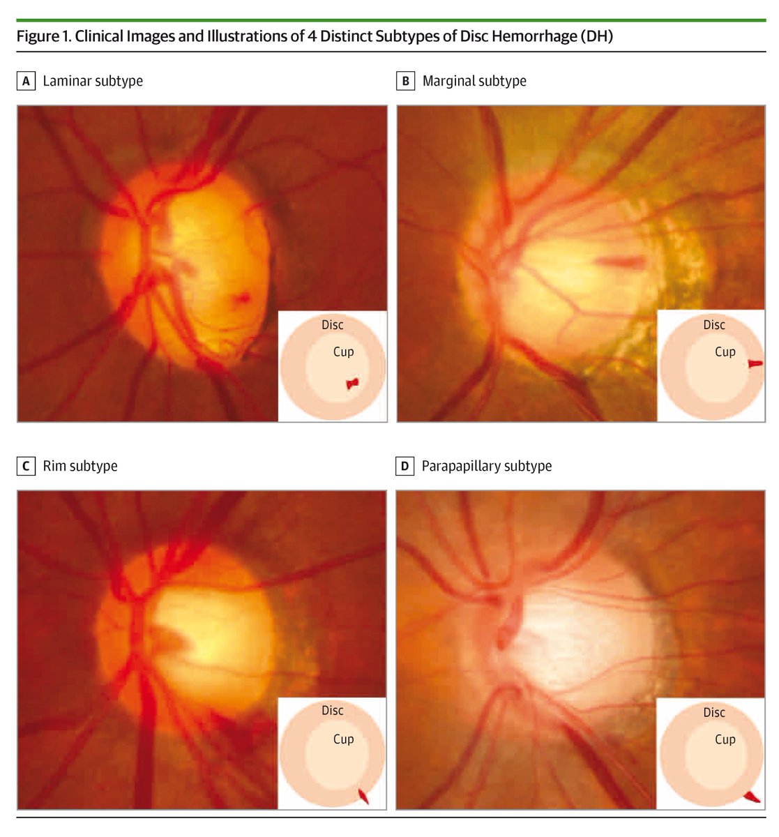 JAMAOphth's tweet photo. Correlation between proximal location of disc hemorrhage and glaucoma progression emphasizes higher risk in cup-type hemorrhage, suggesting disc hemorrhage proximity as a potential predictor for progression. 

https://t.co/JMdV3AOXXs https://t.co/j4ty7SUPbN