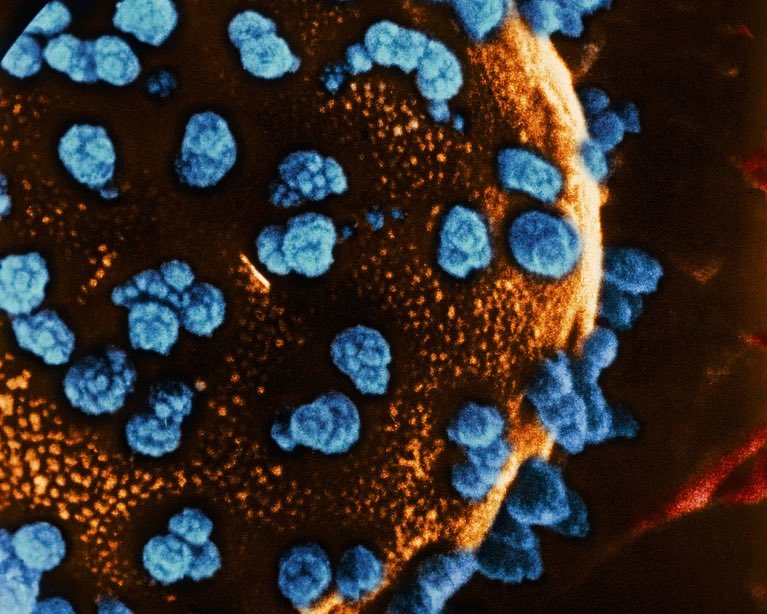Cobra_FX_'s tweet photo. 🚨 Incroyable.

Une femme de 25 ans atteinte de diabète de type 1 a commencé à produire à nouveau sa propre insuline, moins de trois mois après avoir reçu une greffe de cellules souches reprogrammées provenant de son propre corps. https://t.co/ej0SfF5Q3Q