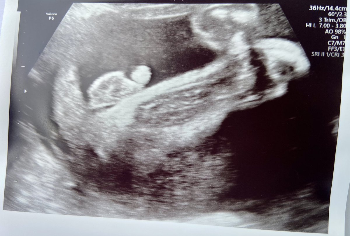 #infertilpreñis #infertilmamis CLARAMENTE niña 👧 durante + de 4 meses…!!! Y ahora, que es un niño 👦😳Ecos mensuales y nunca han tenido atisbo de duda, sobre el sexo, hasta ahora 🤷🏻‍♀️. Aún en shock 🤯 Os ha pasado?!? 🤔 Bien sé que lo importante es que esté bien ❤️🙏