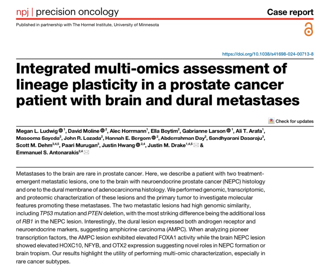EAntonarakis's tweet image. Amphicrine prostate cancer may be a transitional state between prostate adenoCa and small cell/NEPC. Upregulation of FOXA1 and OTX2 may play a role. Congrats to Megan Ludwig for this deep multi-omic analysis. @UMNCancer @umn_dom @DrJustinDrake @aliarafaa nature.com/articles/s4169…
