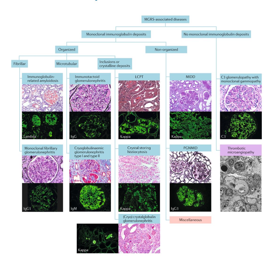 🫘MGRS associated renal lesions 

nature.com/articles/s4158…