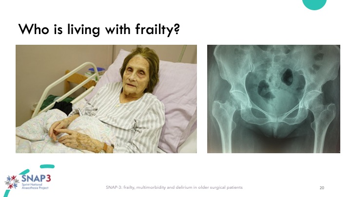 Iain Moppett (@iainmoppett) on Twitter photo SNAP3: Frailty - I suspect these images are stereotypical for many anaesthetists ā frailty equated with a) being in a hospital bed b) ālooking frailā c) being female c) having a hip fracture. But thatās certainly not the whole story <a href="/RCoA_CRI/">RCoA Centre for Research & Improvement</a> <a href="/SNAPs_News/">SNAPs News</a> 11/ SNAP3: Frailty - I suspect these images are stereotypical for many anaesthetists ā frailty equated with a) being in a hospital bed b) ālooking frailā c) being female c) having a hip fracture. But thatās certainly not the whole story <a href="/RCoA_CRI/">RCoA Centre for Research & Improvement</a> <a href="/SNAPs_News/">SNAPs News</a> 11/