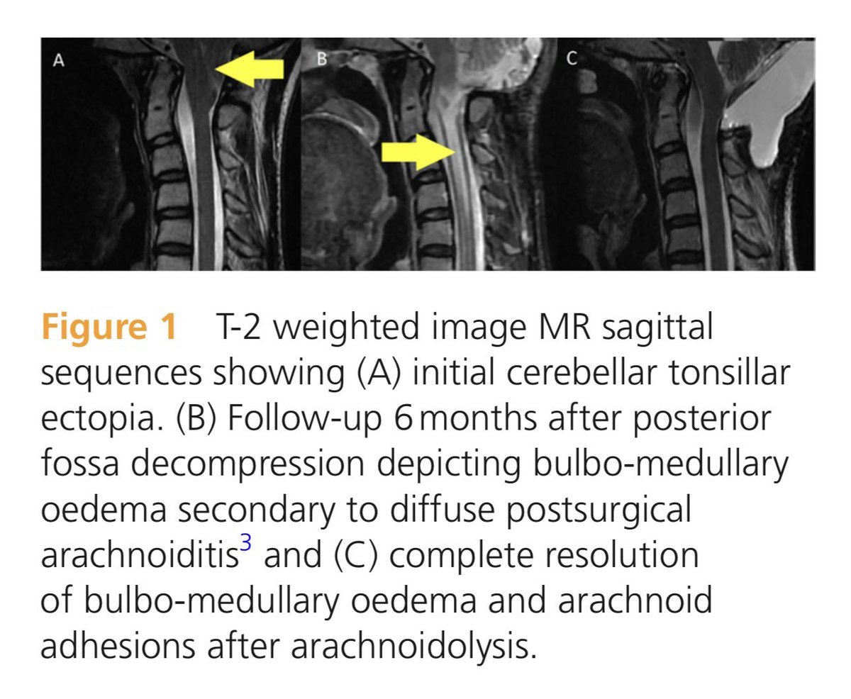 <a href="/PracticalNeuro/">Practical Neurology</a> Measuring changes in intracranial pressure with alterations in posture can identify cerebrospinal fluid blockage at the craniovertebral junction, and so can guide management. <a href="/NeuroRaquisHUMV/">NeuroRaquisHUMV</a> <a href="/aurbsr/">Alvs</a>